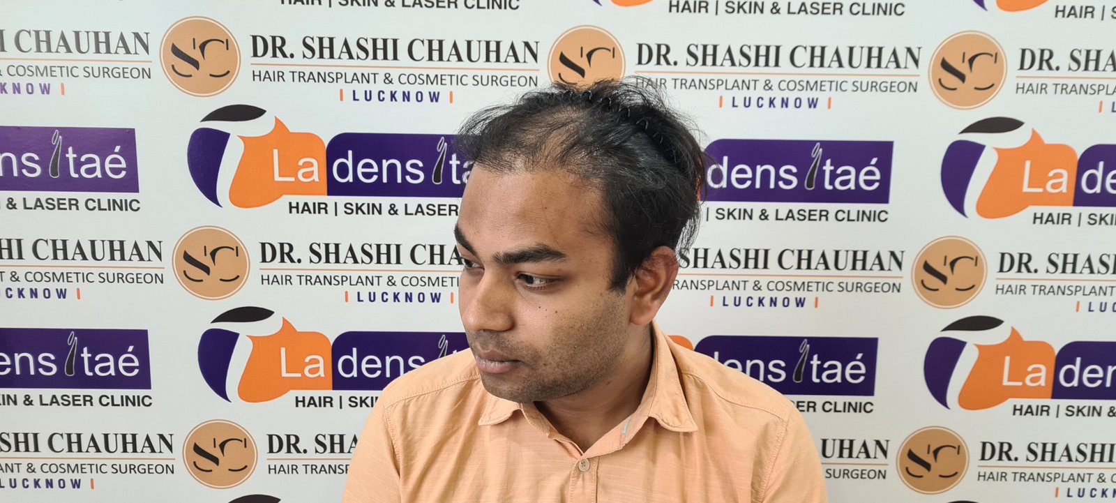 Arnav Dayal Before Hair Transplant